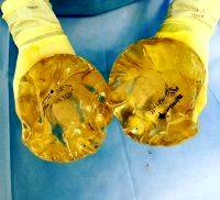Saline Implants Photos